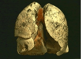 Sigara içen akciğer